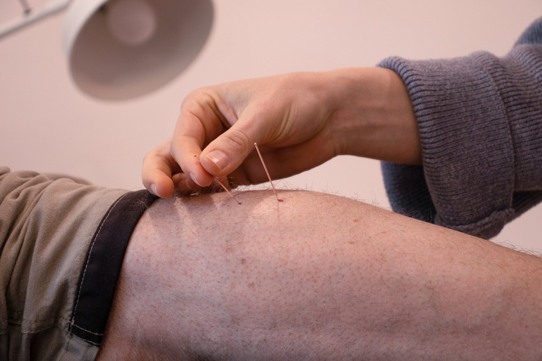 Dry needling of the calf at The Foot Studio