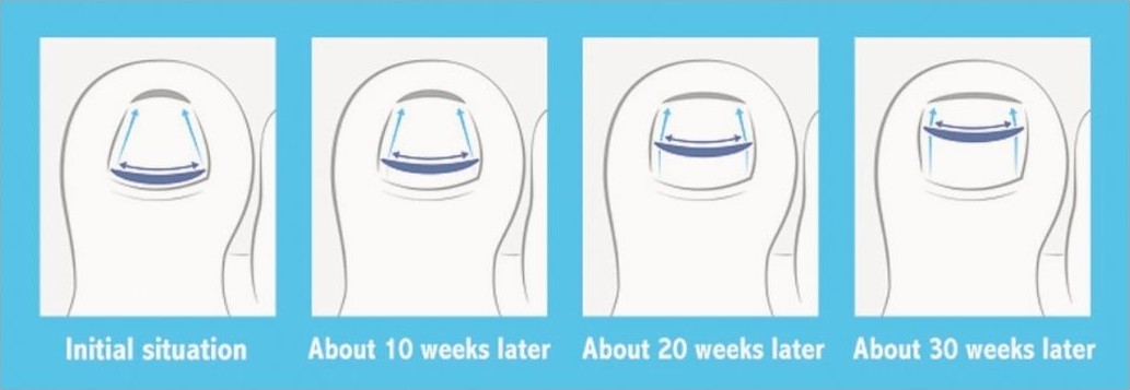 Diagram of an Onyfix brace flattening a curved nail over 30 weeks