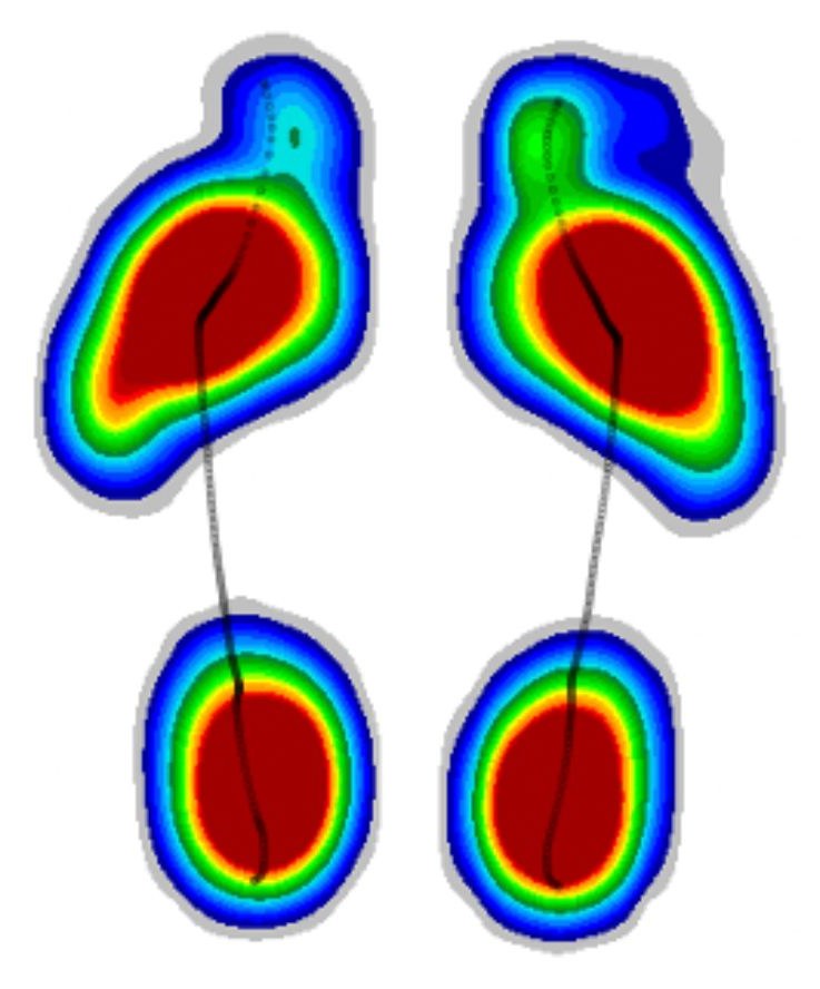 Zebris pressure map showing where pressure builds under both feet when walking